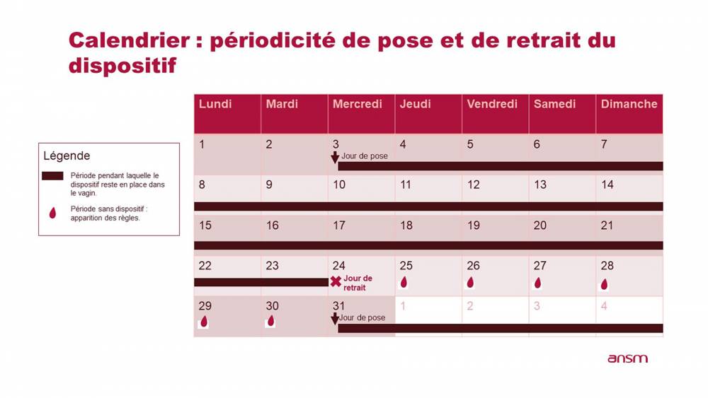 Périodicité de pose et de retrait de l’anneau intravaginal