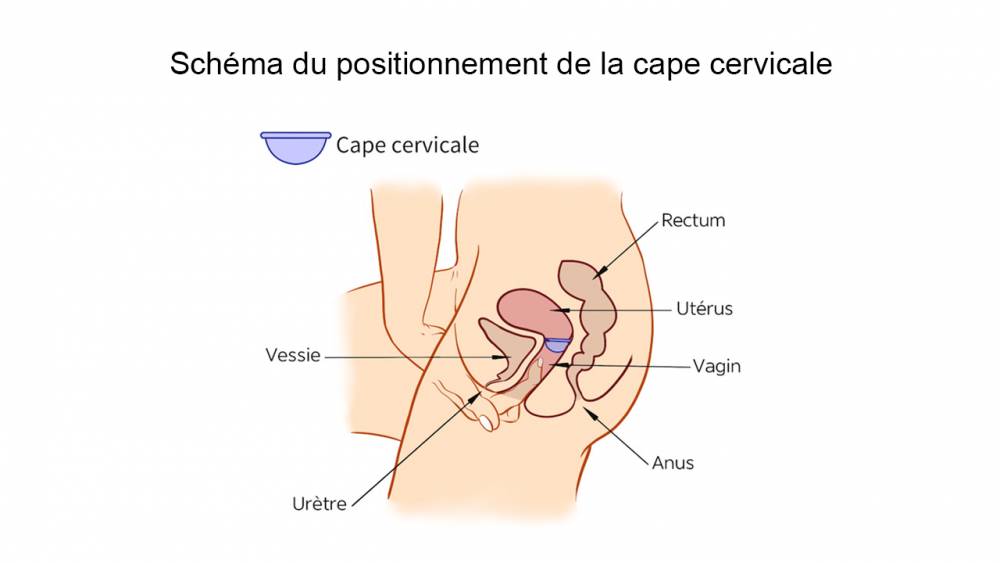 Schéma du positionnement de la cape cervicale (ANSM)