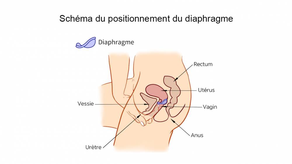 Schéma du positionnement du diaphragme (ANSM)