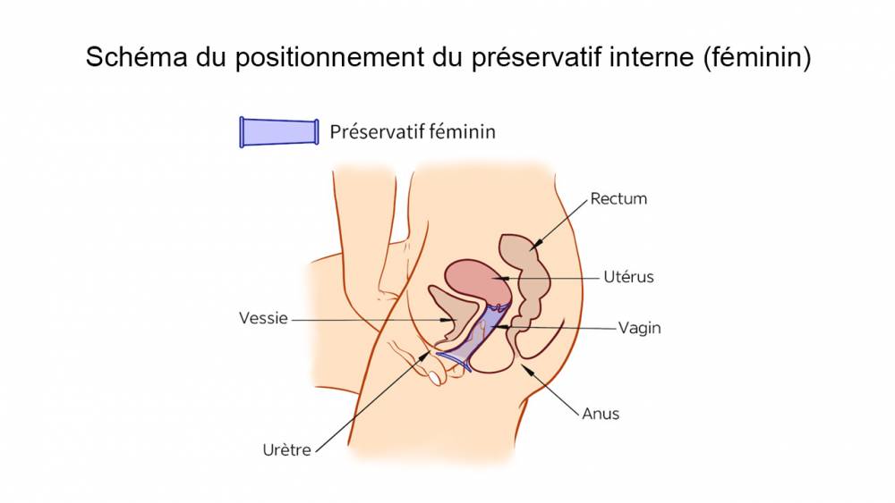 Schéma du positionnement du préservatif interne (féminin) (ANSM)