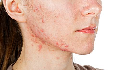 Isotrétinoïne orale et traitement de l’acné sévère