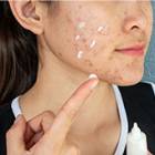 20210309_60_Acne_Isotretinoine_Bon_usage_Femme_applique_creme_170x170