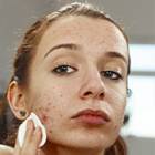 Traitement de l’acné sévère : mieux faire connaître les risques associés à l’isotrétinoïne orale
