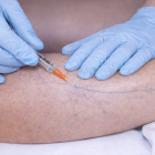 sclérosant veineux2