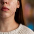 person-dealing-with-rosacea_Freepik_170x170