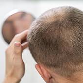 Male-Adulte-Ayant-Des-Problemes-De-Calvitie_Freepik