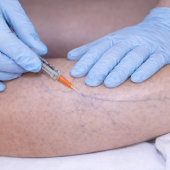 sclérosant veineux2