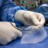Qu’est-ce qu’un implant de renfort pariétal ?